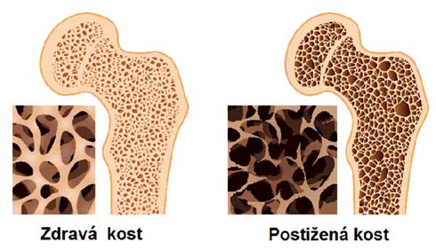 Osteoporóza nemá šanci