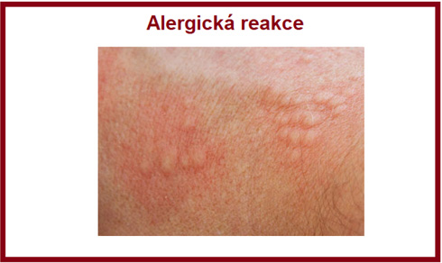 Potravinová alergie bývá na začátku