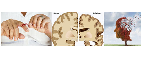 Alzheimerova choroba a proces stárnutí