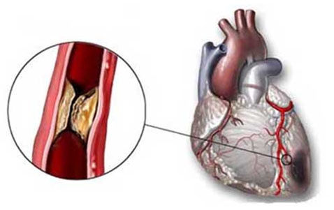 Angina pectoris